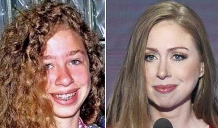 Chelsea Clinton Plastic Surgery - Beauty Enhancement.